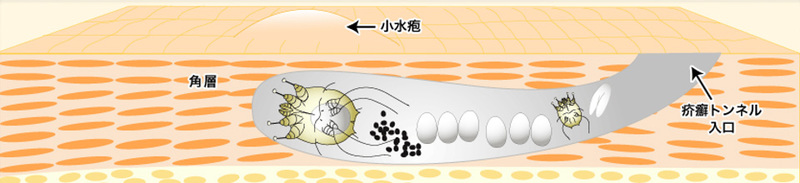 風呂 疥癬 熱い