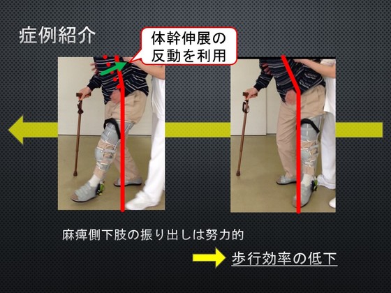 誠実】 脳卒中片麻痺患者の歩行トレーニングにおける 長下肢装具の 